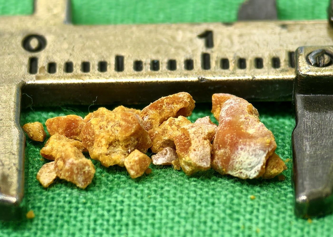 游標卡尺旁的一排結石碎粒,呈鮮明的橘黃色並夾雜淡色斑塊,表面凹凸不平,整排寬度約一公分