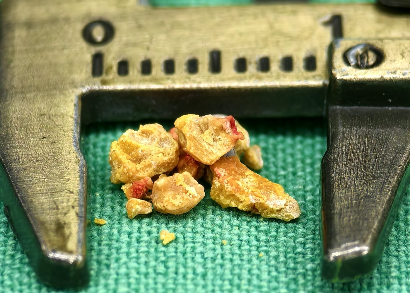 游標卡尺旁的尿酸結石檢體,呈鮮明的橙黃色,部分帶有紅色斑點,表面較為圓鈍,卡尺刻度顯示整組不到一公分寬