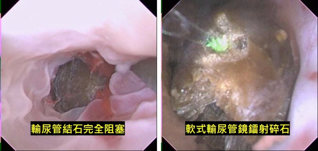 同一位病人的兩張內視鏡畫面併排：左側標示「輸尿管結石完全阻塞」，深色結石把管腔整個填滿；右側標示「軟式輸尿管鏡鐳射碎石」，雷射光纖抵著結石發出綠色亮點