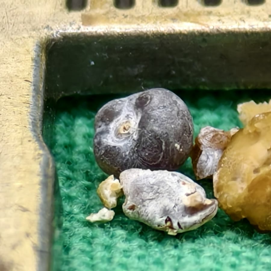 綠色手術布上，游標卡尺的鉗口裡放著幾顆小結石，中間一顆深灰藍色、圓圓的，像一顆藍莓