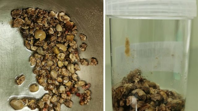 手術取出的結石，左邊是攤在不鏽鋼盤上密密麻麻的褐色碎石，右邊是裝滿同一批碎石的檢體罐