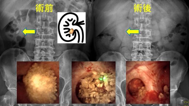 術前與術後的腹部 X 光併排，兩張都以箭頭指向同一處，下方疊著三張手術中的內視鏡畫面，從完整的結石到打碎後的腎盞