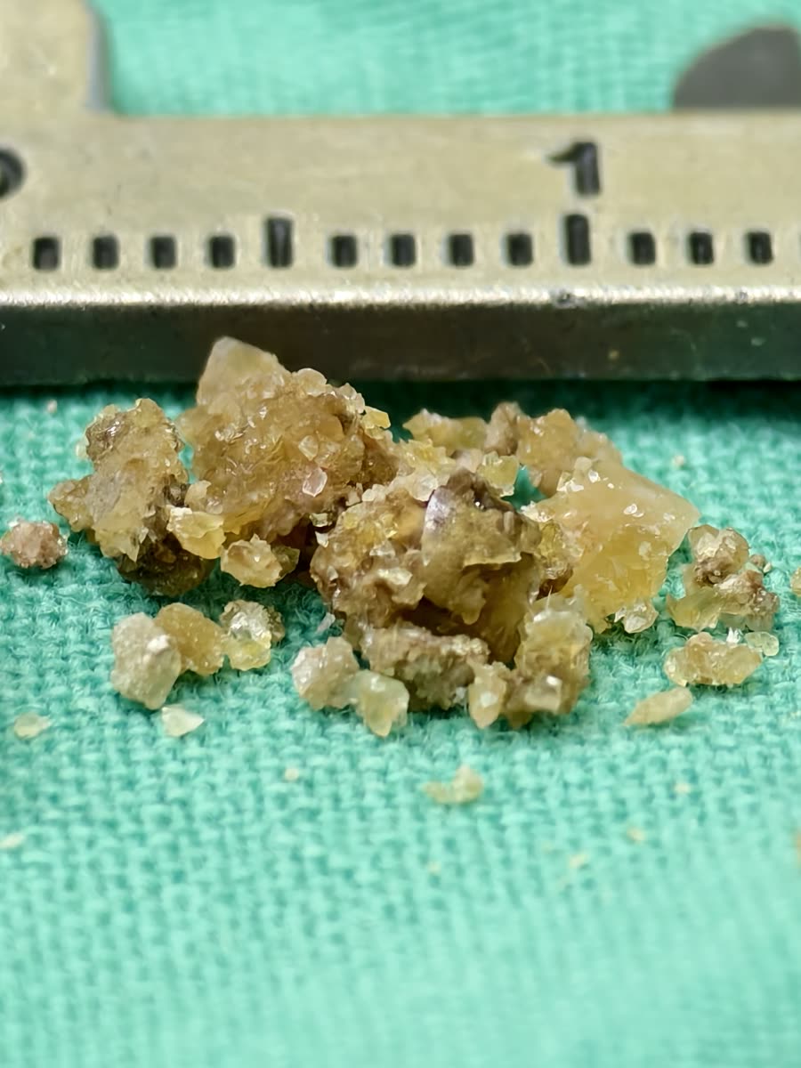 卡尺內一堆黃褐色、半透明的結晶碎塊