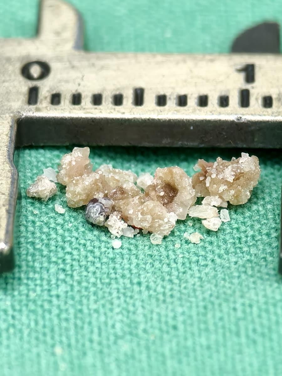 卡尺內一排米白到淡褐色、表面有細小結晶的碎石