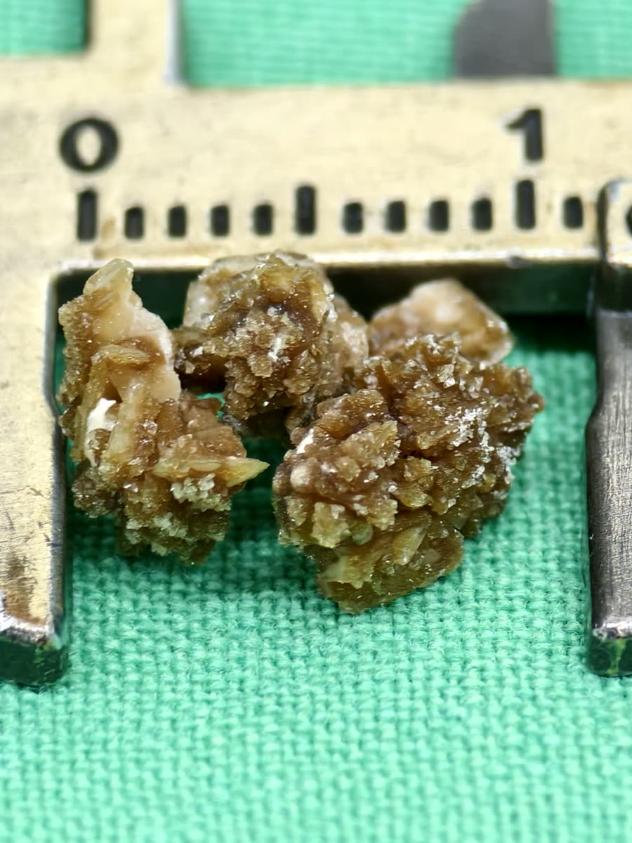卡尺內幾顆聚在一起的黃褐色結石,表面布滿尖刺狀的結晶