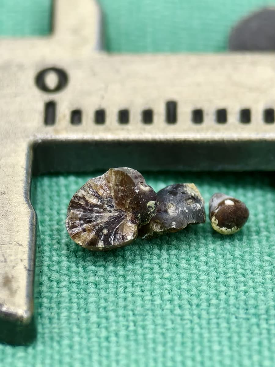 卡尺內一顆剖開的深褐色結石,斷面看得到放射狀的紋路,旁邊還有兩小塊結石