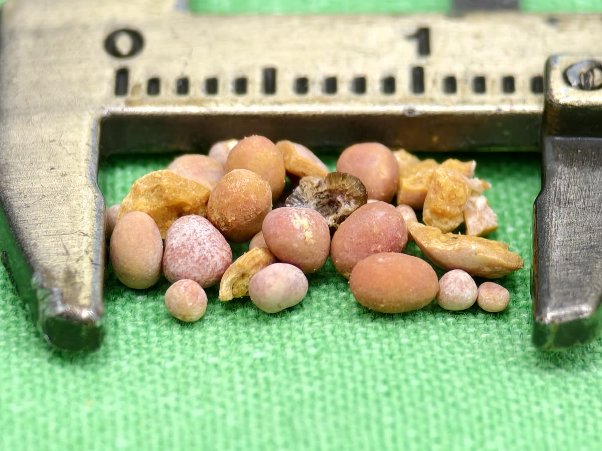 卡尺內一堆粉紅、橘黃色的圓形小結石,夾著幾塊黃色碎片