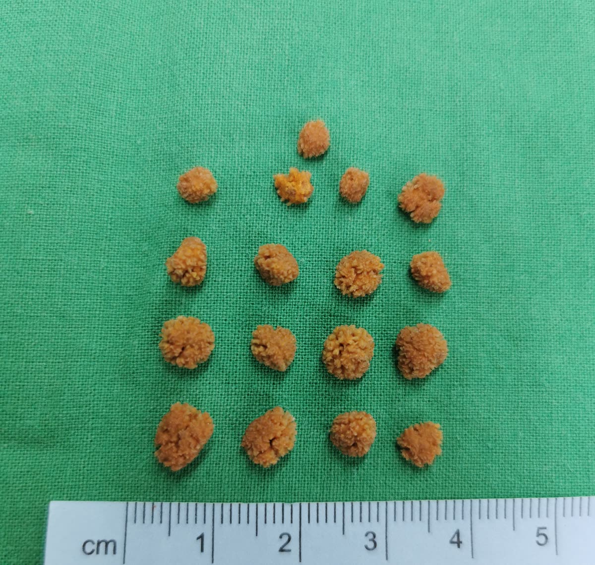 綠布上排成方陣的十幾顆橘黃色、像小毛球的結石,下方放著公分尺